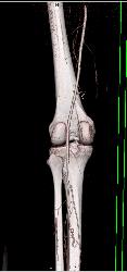 GSW Knee With Vascular Injury - CTisus CT Scan