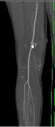 GSW Knee With Vascular Injury - CTisus CT Scan