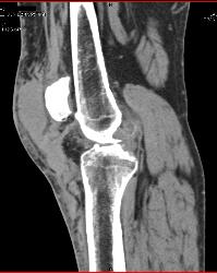 Hematoma Near Patellar Ligament - CTisus CT Scan