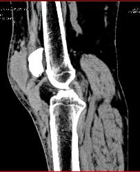 Hematoma Near Patellar Ligament - CTisus CT Scan