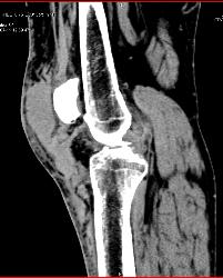 Hematoma Near Patellar Ligament - CTisus CT Scan