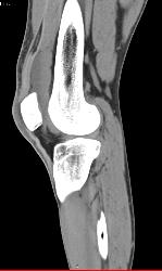 Suprapatellar Bursal Hemorrhage S/p Trauma - CTisus CT Scan