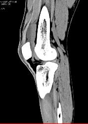 Suprapatellar Bursal Hemorrhage S/p Trauma - CTisus CT Scan