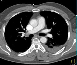 Thoracic Stab Wound With Bleed in Posterior Left Paraspinal Muscles - CTisus CT Scan