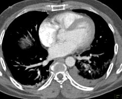 Thoracic Stab Wound With Bleed in Posterior Left Paraspinal Muscles - CTisus CT Scan