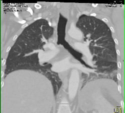 Thoracic Stab Wound With Bleed in Posterior Left Paraspinal Muscles - CTisus CT Scan