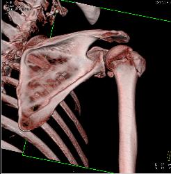 Humerus and Scapular Fractures - CTisus CT Scan