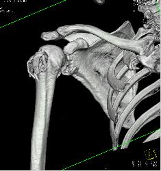 Humerus and Scapular Fractures - CTisus CT Scan