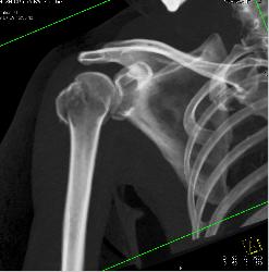 Humerus and Scapular Fractures - CTisus CT Scan