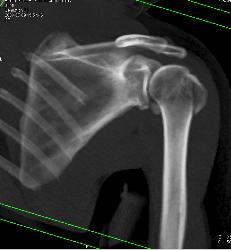 Humerus and Scapular Fractures - CTisus CT Scan