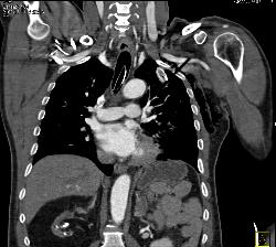 Broken Blade in Chest. Amazing Images Look Like Artifact - CTisus CT Scan