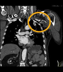 Broken Blade in Chest. Amazing Images Look Like Artifact - CTisus CT Scan