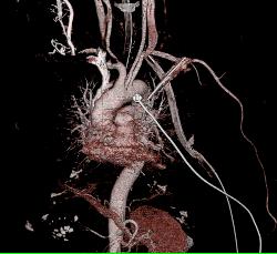 Broken Blade in Chest. Amazing Images Look Like Artifact - CTisus CT Scan