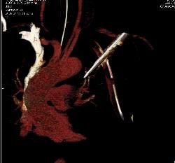 Broken Blade in Chest. Amazing Images Look Like Artifact - CTisus CT Scan