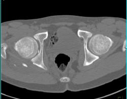 Joint Fragment in Right Hip Joint Following Dislocation/fracture and Reduction. Posterior Acetabular Fracture Also Seen - CTisus CT Scan