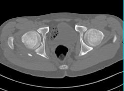 Joint Fragment in Right Hip Joint Following Dislocation/fracture and Reduction. Posterior Acetabular Fracture Also Seen - CTisus CT Scan