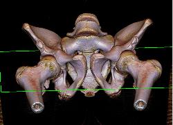 Joint Fragment in Right Hip Joint Following Dislocation/fracture and Reduction. Posterior Acetabular Fracture Also Seen - CTisus CT Scan