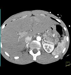 Dense Adrenals in Shock Patient S/p Trauma - CTisus CT Scan