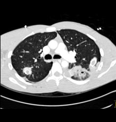 Pulmonary Laceration - CTisus CT Scan