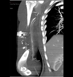 GSW With Humerus Fracture and Trauma to Brachial Artery - CTisus CT Scan