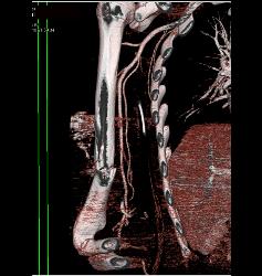 GSW With Humerus Fracture and Trauma to Brachial Artery - CTisus CT Scan