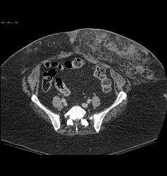 Abdominal Wall Hematoma S/p MVA - CTisus CT Scan