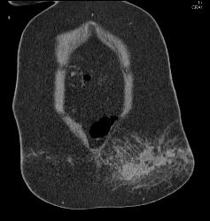 Abdominal Wall Hematoma S/p MVA - CTisus CT Scan