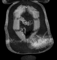 Abdominal Wall Hematoma S/p MVA - CTisus CT Scan