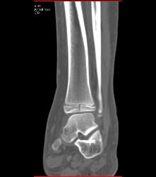 Tibial Fracture - CTisus CT Scan