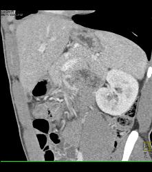 Subtle Pancreatic Laceration - CTisus CT Scan