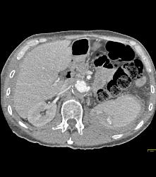 Splenic Laceration and Active Bleed - CTisus CT Scan