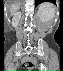 Splenic Laceration and Active Bleed - CTisus CT Scan