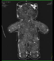 Bear Without Trauma - CTisus CT Scan