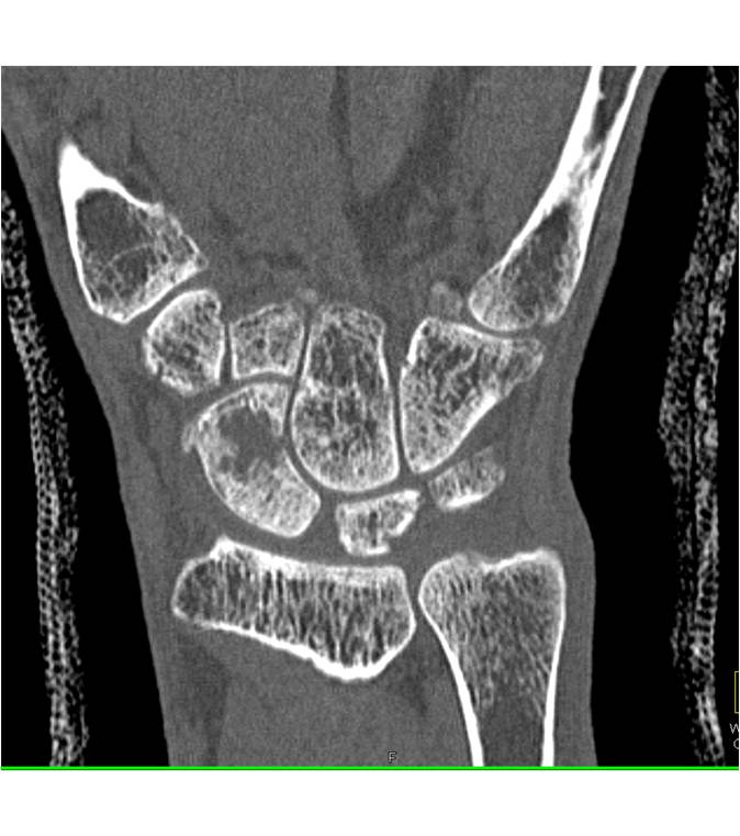 Nonunion of a Scaphoid Fracture - CTisus CT Scan