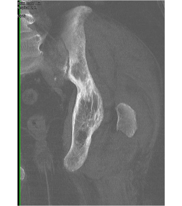 Femur Fracture and Paget's Disease - CTisus CT Scan