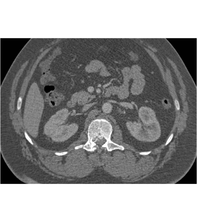 Burst Fracture L1 - CTisus CT Scan