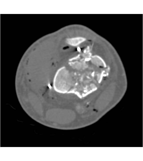 Gunshot to Distal Femur with Multiple Fracture Fragments but no Evidence of Vascular Injury on CTA - CTisus CT Scan