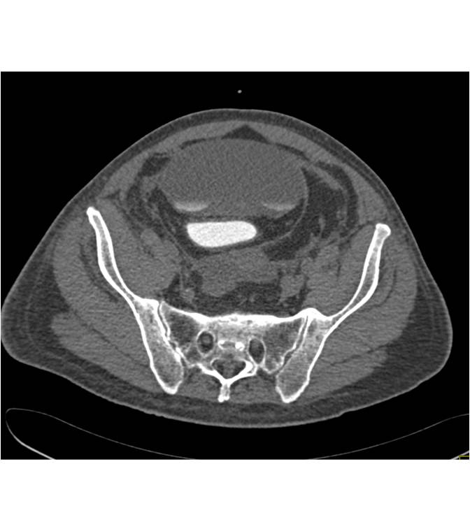 Bladder Leak on CT Cystogram s/p Laparoscopic prostatectomy - CTisus CT Scan