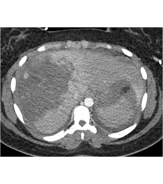 Hepatic and Splenic Lacerations s/p Trauma - CTisus CT Scan