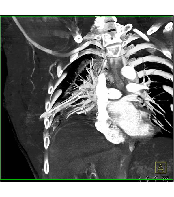 Chest Wall Bleed as Well as Pulmonary Contusion and Bleed - CTisus CT Scan