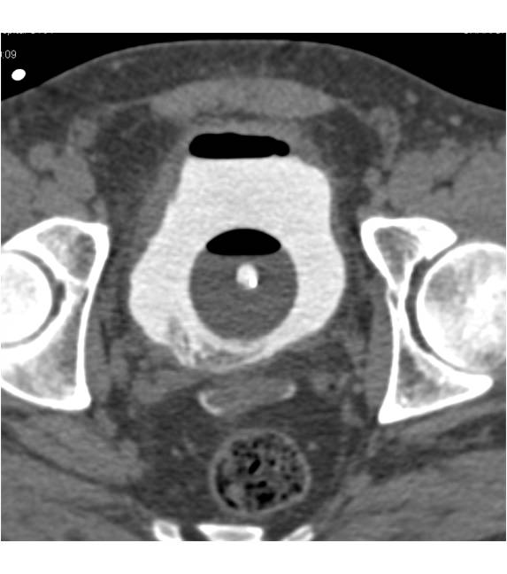 Renal Laceration s/p Biopsy - CTisus CT Scan