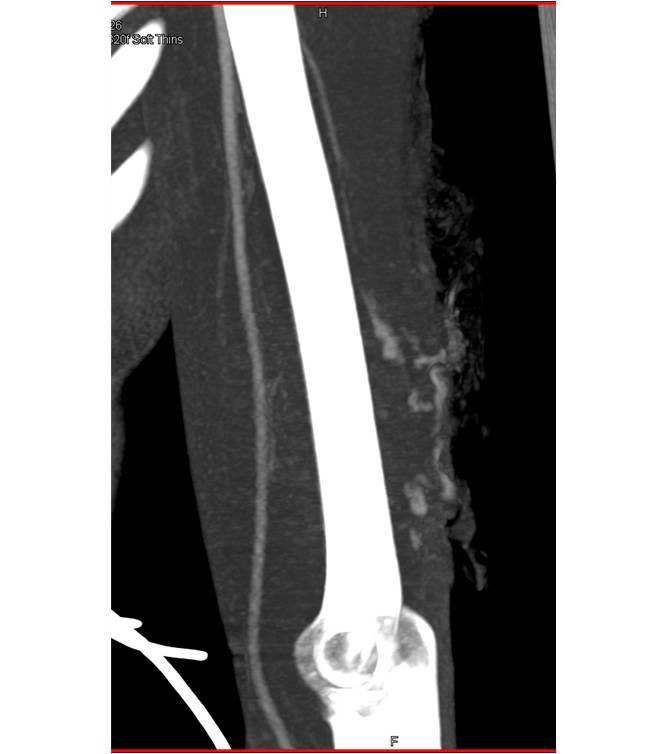 Stab Wound Above Elbow with Active Bleed - CTisus CT Scan