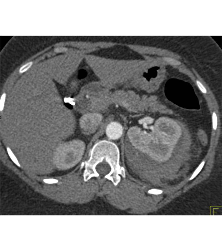 Renal Laceration with Perirenal Blood due to Trauma - CTisus CT Scan