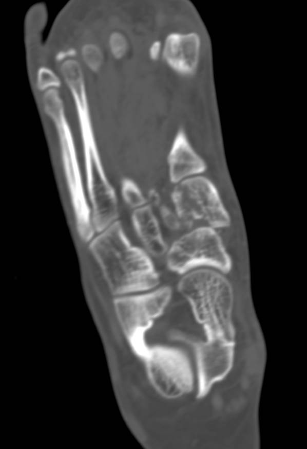 Medial Cuneiform Fracture - CTisus CT Scan