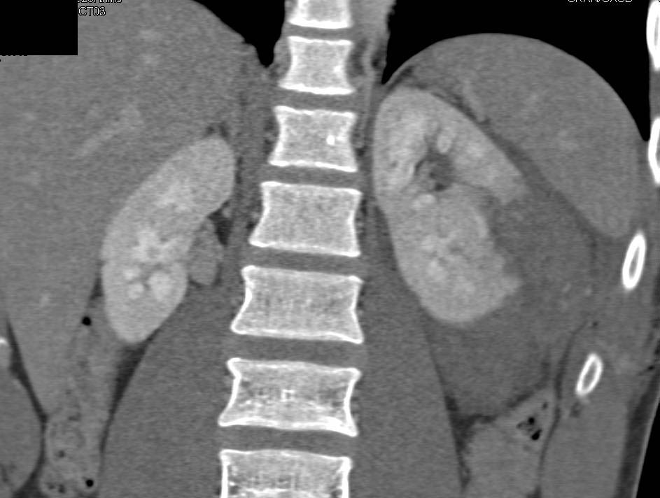 Renal Laceration with Perirenal Blood due to Trauma in Patient with femur Fracture as well - CTisus CT Scan