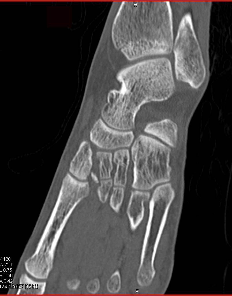 Multiple Fractures Including Midfoot, Pelvis and Abdominal Wall in 3D - CTisus CT Scan