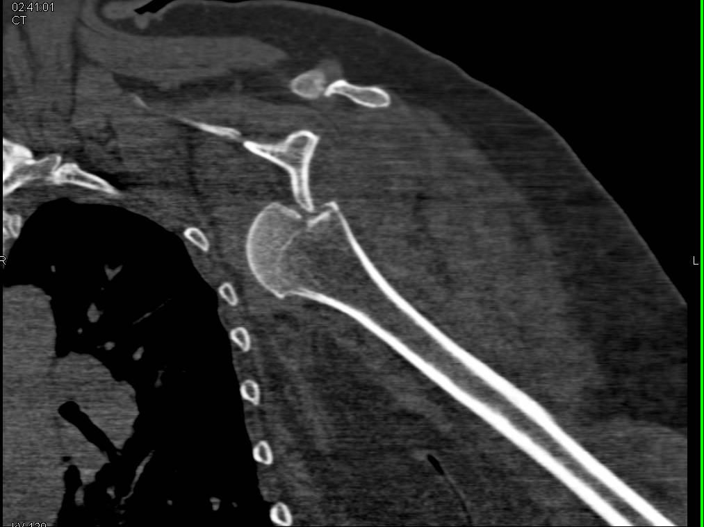 Fracture/Dislocation of Left Humeral Head - CTisus CT Scan