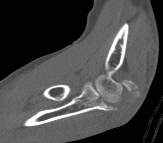 Ulnar Fracture - CTisus CT Scan