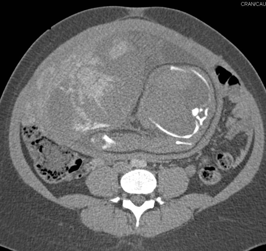 MVA with Injury to the Placenta with Bleed into Placenta with Perfusion Changes. The Baby was then delivered. - CTisus CT Scan