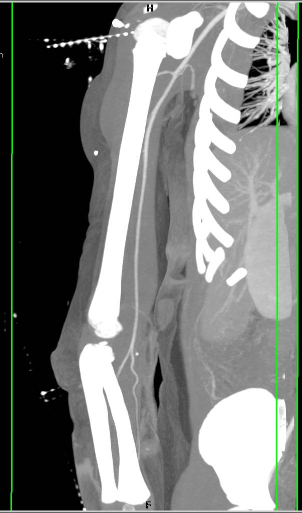 Trauma Left Arm Without Vascular Injury - CTisus CT Scan